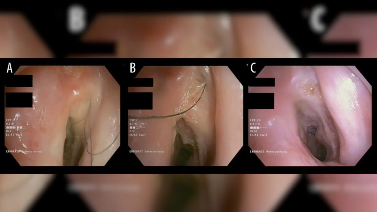 52-Year-Old Man Grows Rare Hair In Throat After Years Of Heavy Smoking