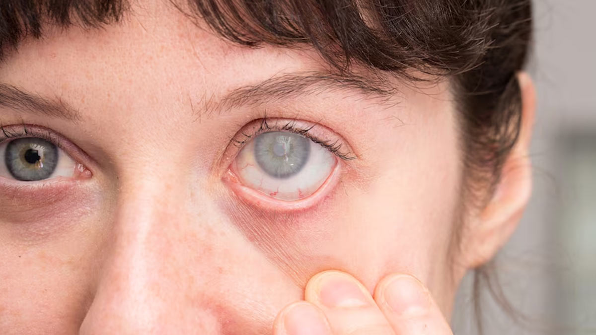 Cataract Awareness Month: Can Cataract Be Prevented? Doctor Shares Tips To Avoid It