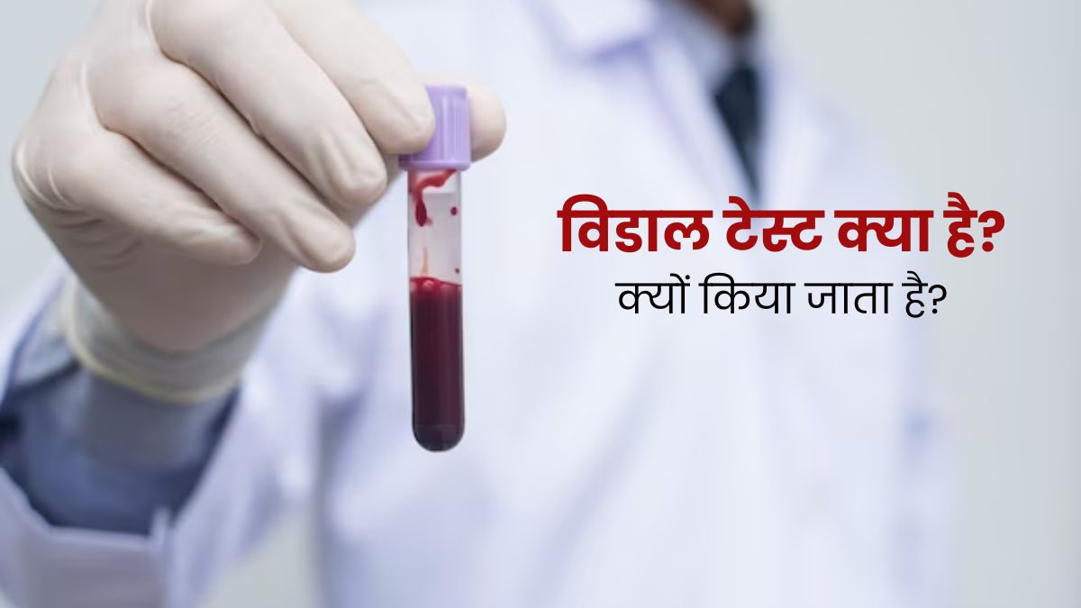 विडाल टेस्ट क्यों किया जाता है? जानें इसकी नॉर्मल रेंज और जरूरत
