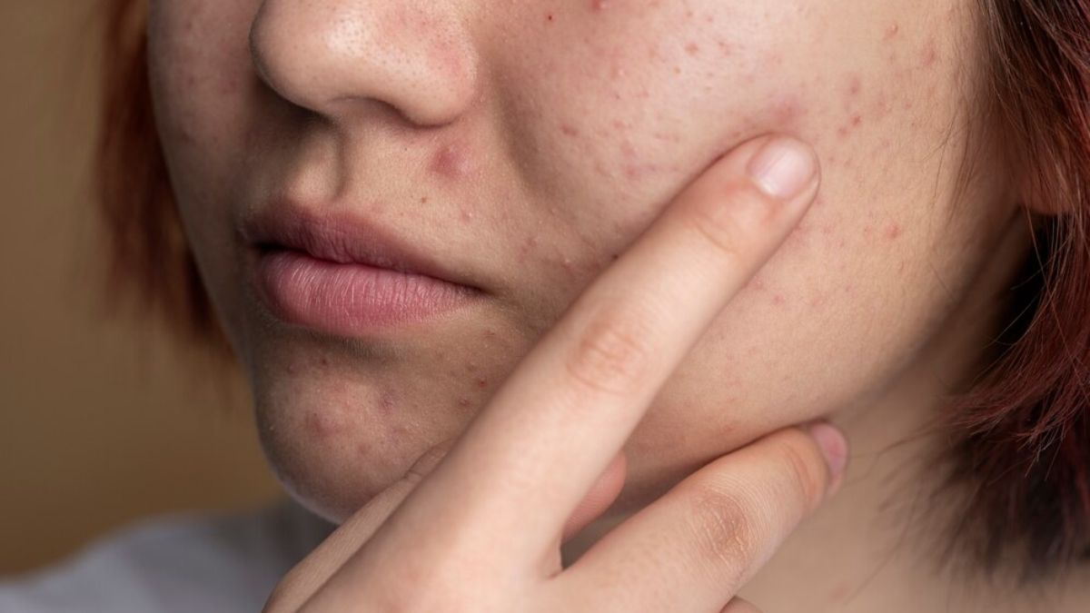 how to treat under the skin pimples