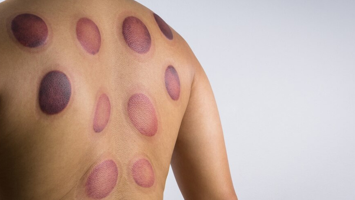 Risk Factors for Developing Shingles