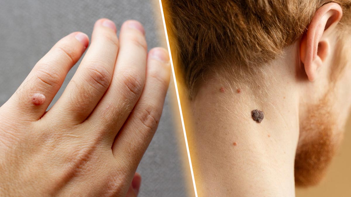 Skin Tags Vs Warts: Expert Explains The Differences Between The Two