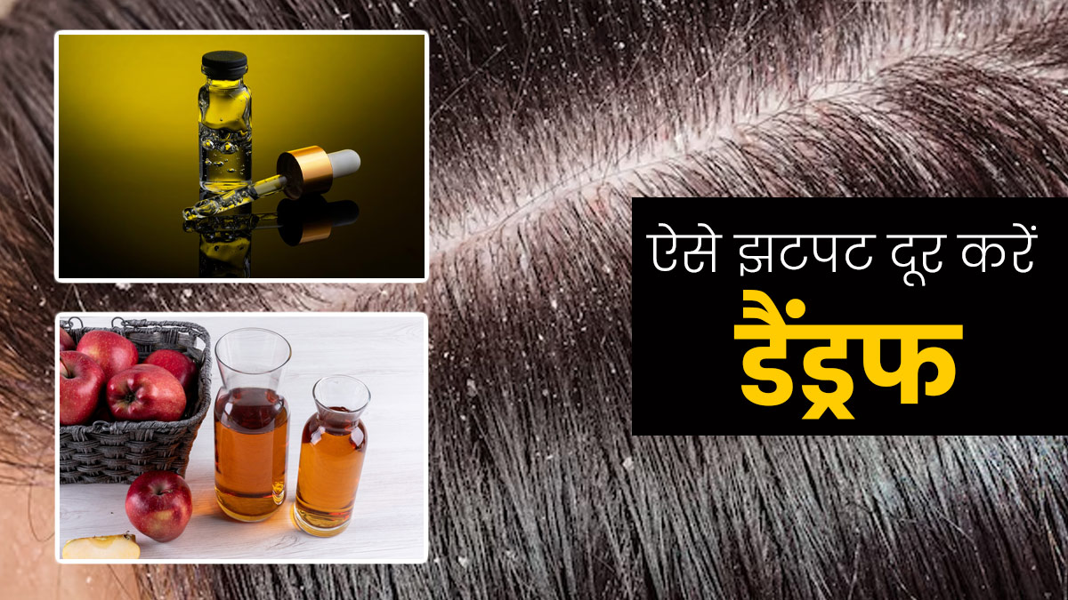 डैंड्रफ दूर करने के लिए आजमाएं एप्‍पल साइडर व‍िनेगर और ऑल‍िव ऑयल से बना यह हेयर मास्क 