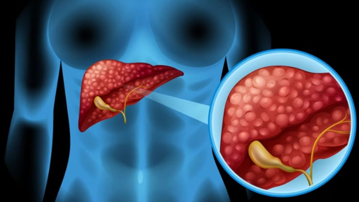 gall bladder stone in hindi
