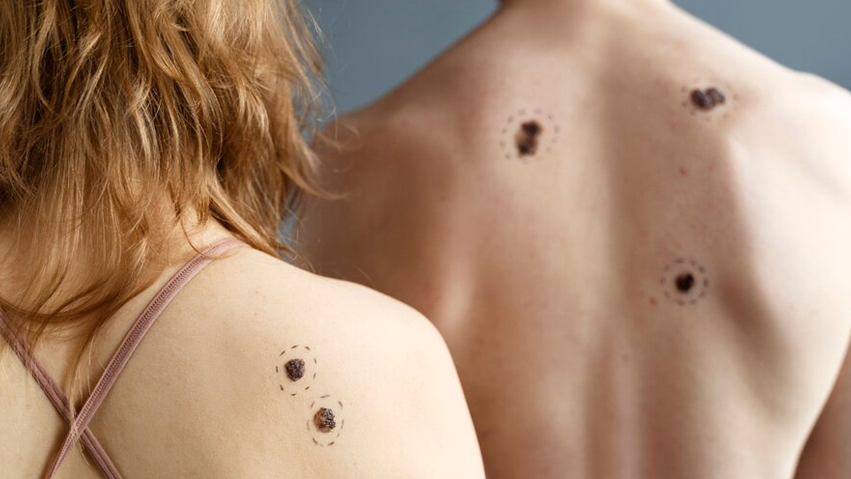 skin-tags