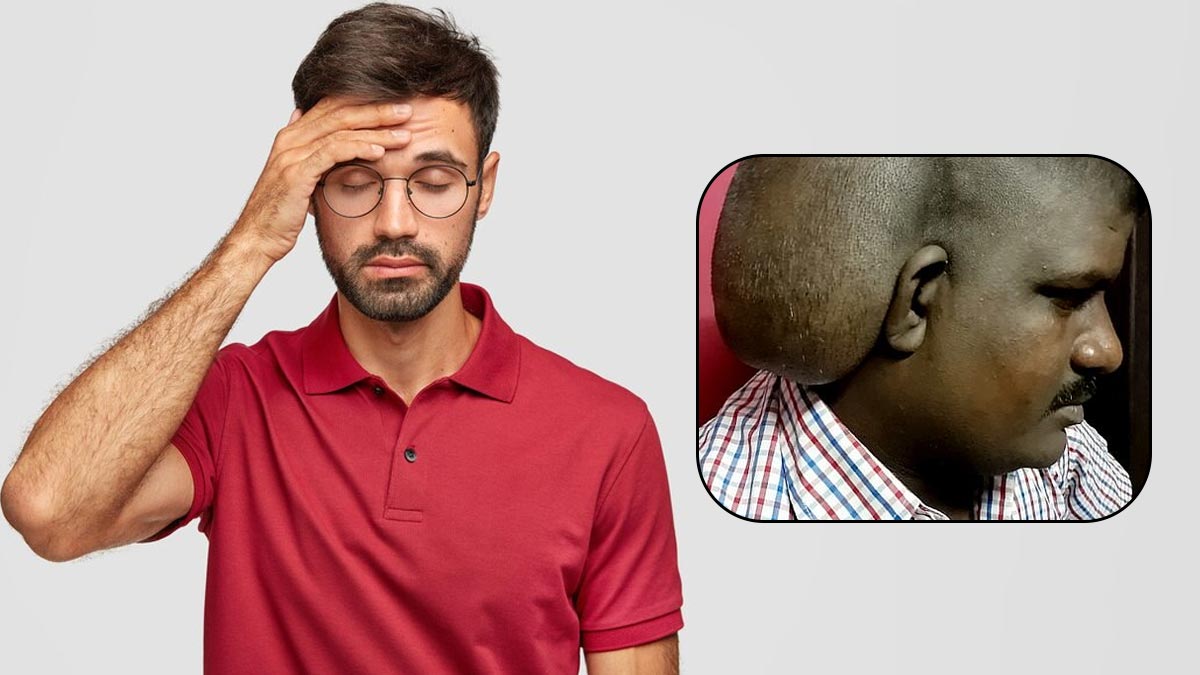 डॉक्टरों ने 15 साल बाद मरीज के सिर से निकाला खरबूजे जितना बड़ा ट्यूमर, 24 साल की उम्र से था पीड़ित 