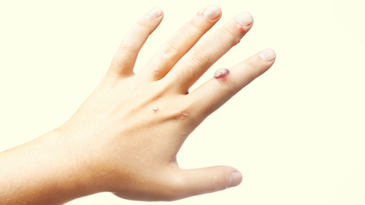 warts