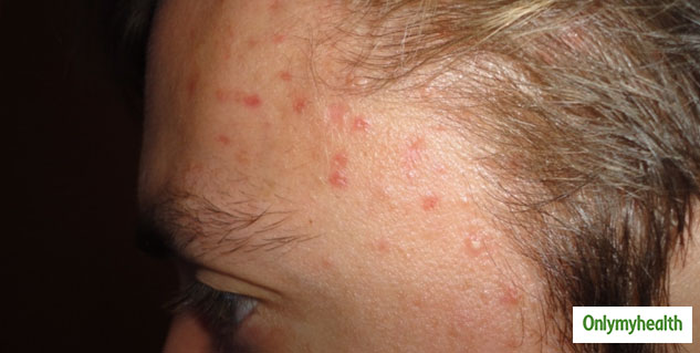 Dermatologist Decodes Forehead Acne Causes and Treatment Options ...