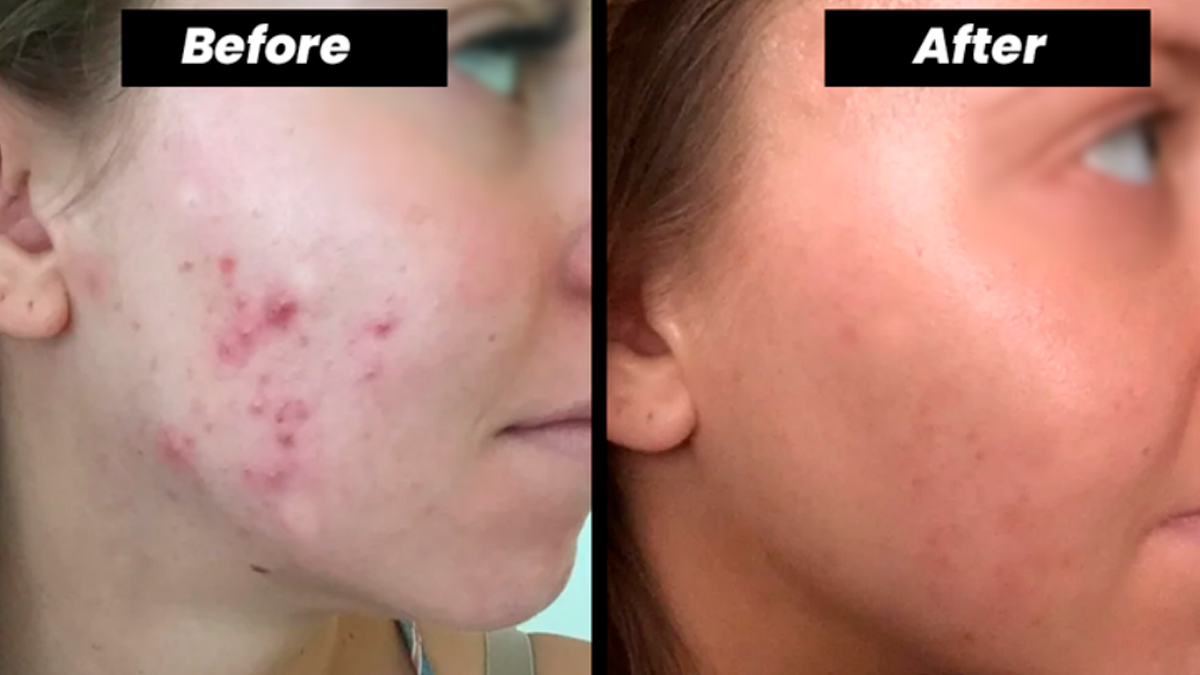 Tretinoin Cream uk