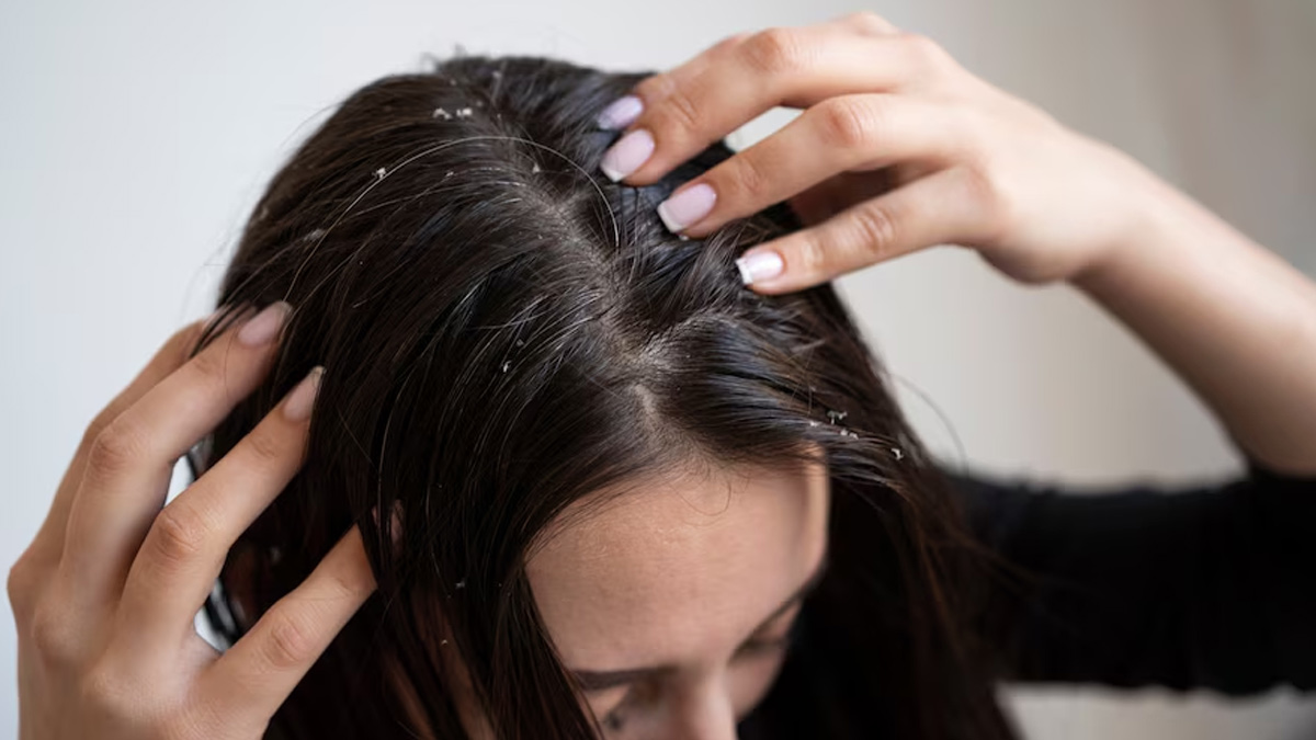 can hormonal changes cause dandruff