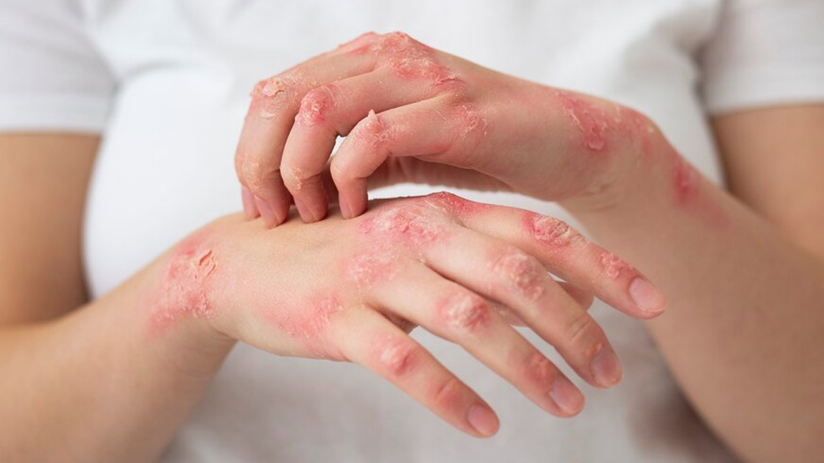 What Is Psoriasis? What Are Its Causes, Symptoms, And Types? – MyCocoSoul