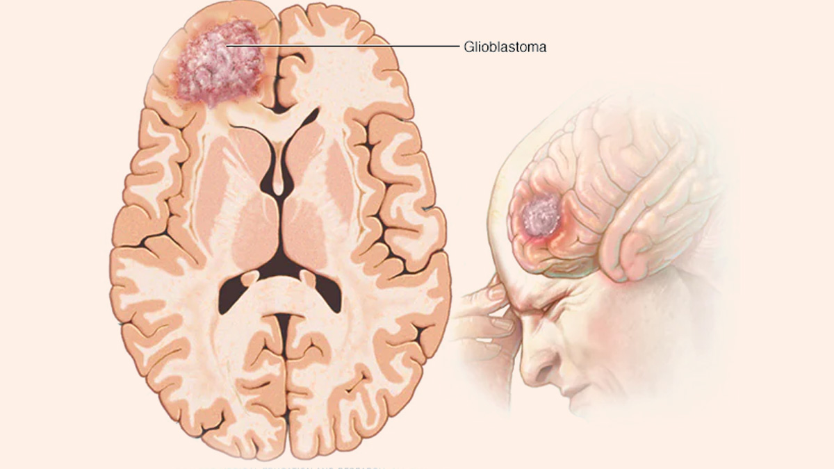 Glioblastoma