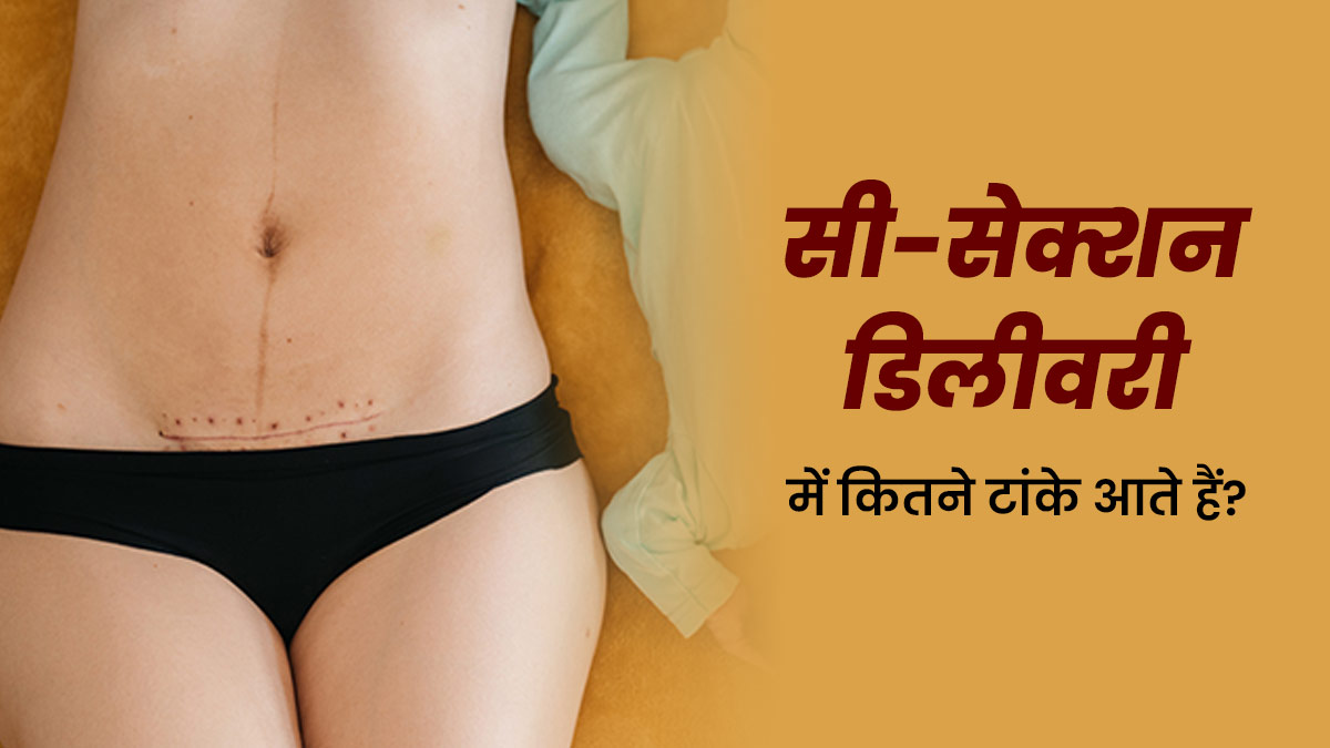 सी-सेक्शन डिलीवरी में कितने टांके लगते हैं? डॉक्टर से जानें कैसे करें इनकी देखभाल