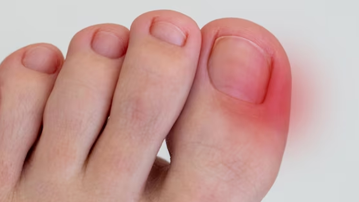 Ingrown Nail Or Onychocryptosis Concept Foot Of Scandinavian Child With Red  Spot On Big Toe Stock Photo - Download Image Now - iStock