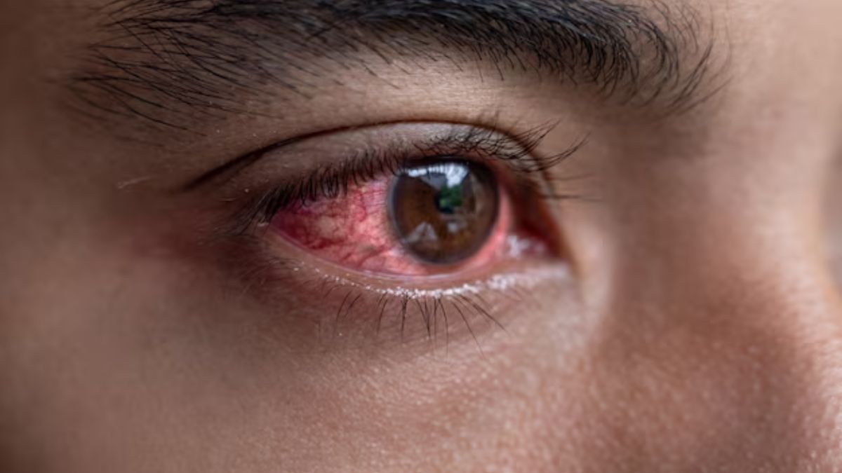 Avoid These Dietary Habits If You Are Dealing With Conjunctivitis