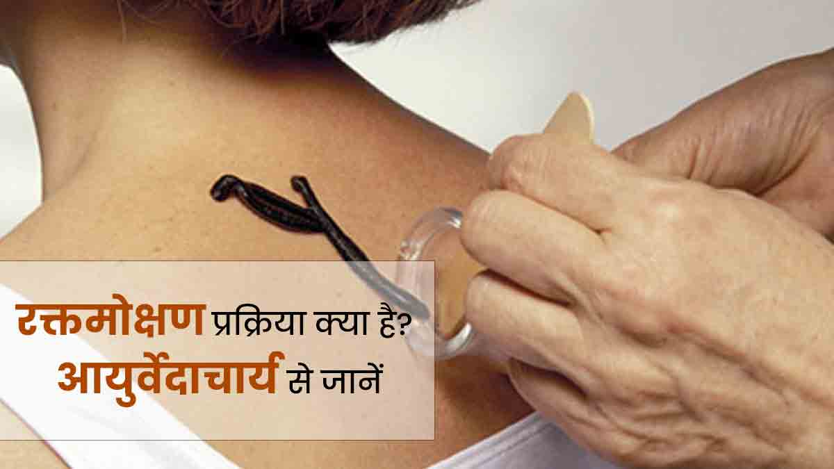 रक्तमोक्षण क्या है? आयुर्वेदाचार्य से जानें इसकी प्रक्रिया और फायदे