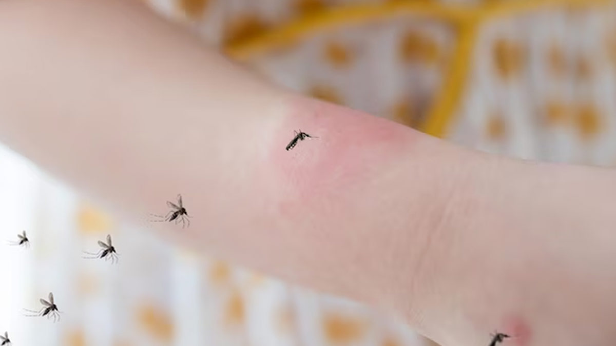 mosquito bite swelling treatment
