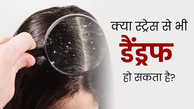 क्या ज्यादा स्ट्रेस लेने से भी हो जाता है डैंड्रफ? एक्सपर्ट से जानें