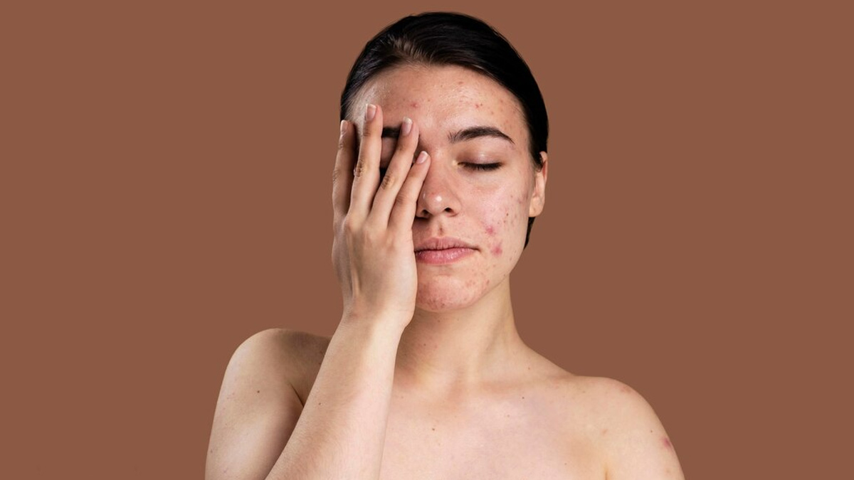 Cancer-Causing Chemical Benzene Found In Leading Acne Products In US, Try These Natural Alternatives Instead