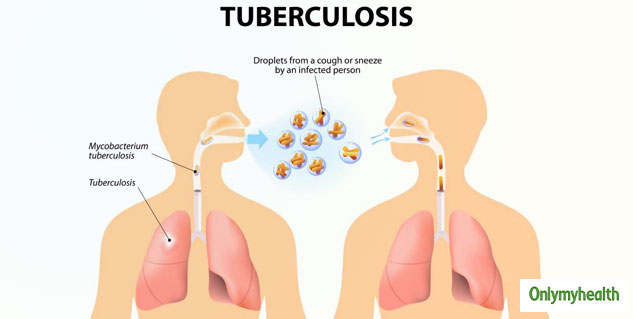 World Tuberculosis Day 2024 Link Between Regular Physical Activity and Respiratory Health