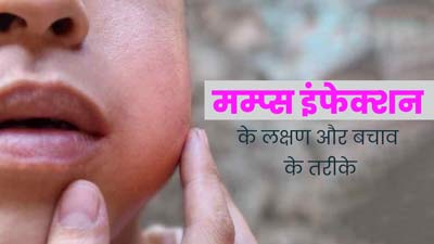 केरल में बच्चों में फैल रही है मम्प्स की खतरनाक बीमारी, एक दिन में मिले 190 केस, जानें इसके लक्षण