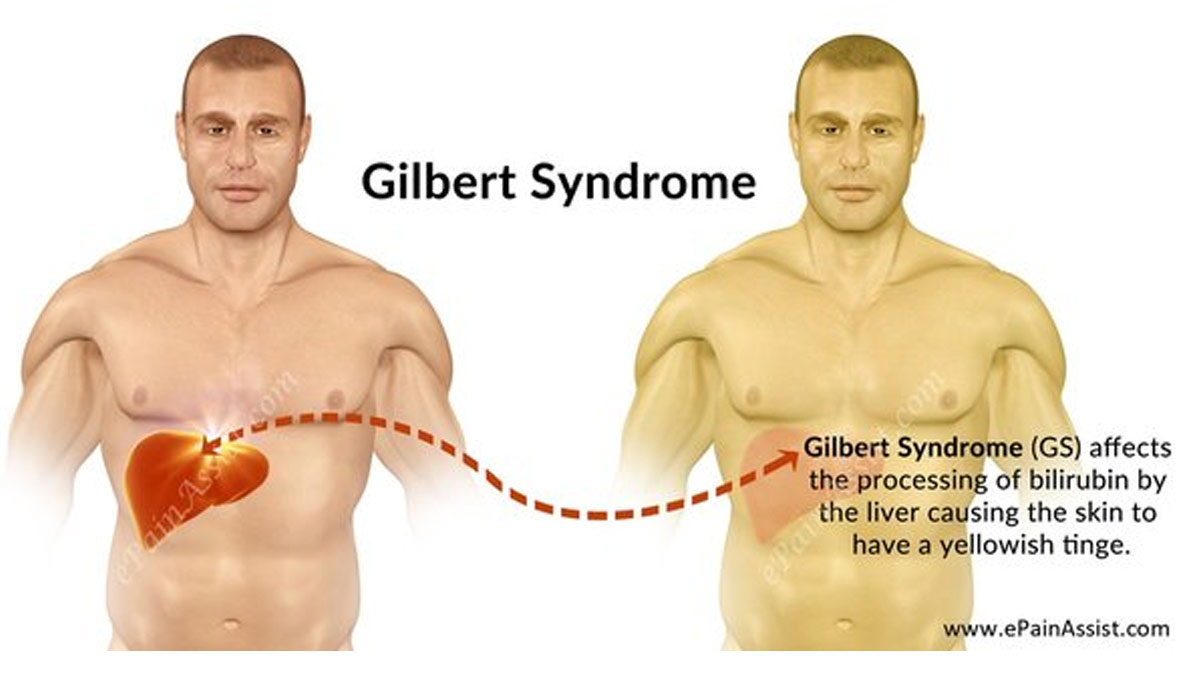 Gilbert Syndrome