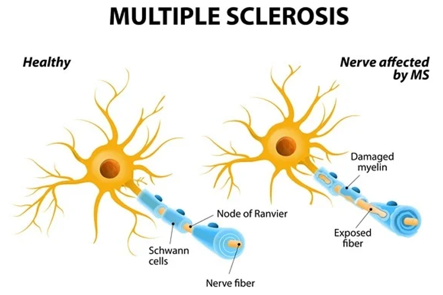 Multiple Sclerosis