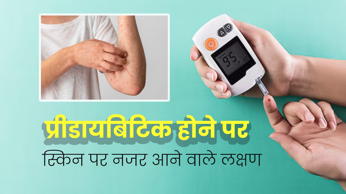 Prediabetes Symptoms: प्री-डायबिटीज होने पर त्वचा पर नजर आते हैं ये 5 लक्षण, न करें अनदेखी