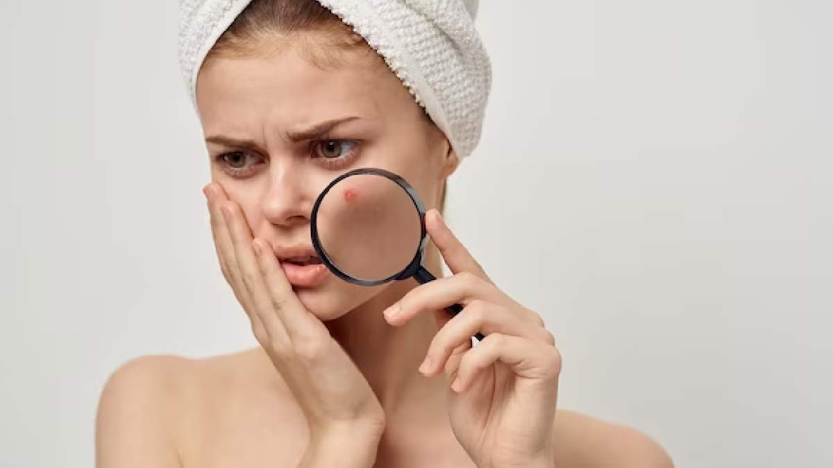 how to remove redness from pimples