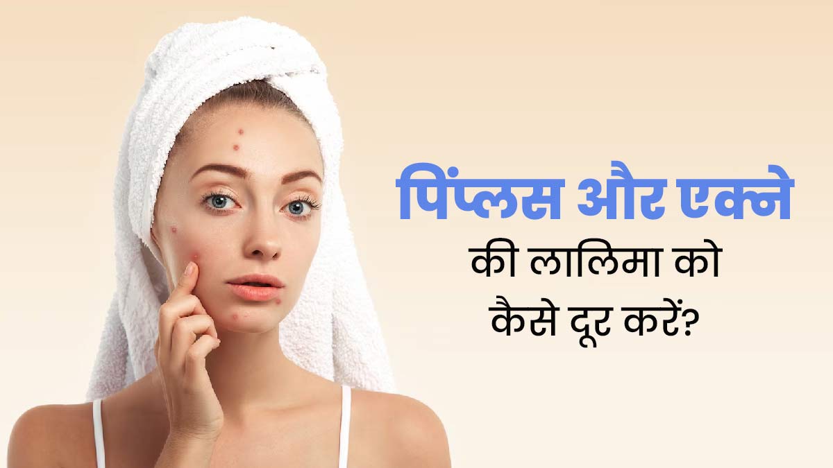 चेहरे पर पिंपल्स की वजह से हो गई है रेडनेस, तो राहत पाने के लिए अपनाएं ये उपाय