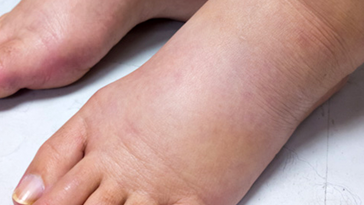 swelling in legs