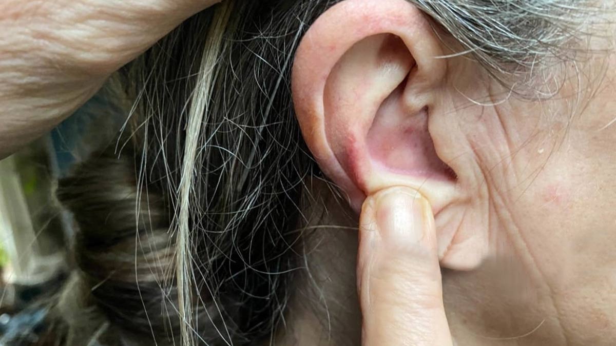 Pimple On Ears: Here's How You Can Get Rid of it