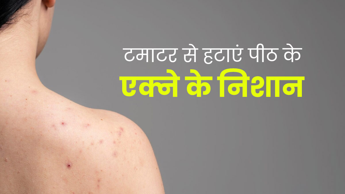 पीठ पर हुए एक्ने के निशान हटाने के लिए टमाटर का इस्तेमाल कैसे करें? जानें 3 तरीके, जिनसे दूर होंगे दाग-धब्बे
