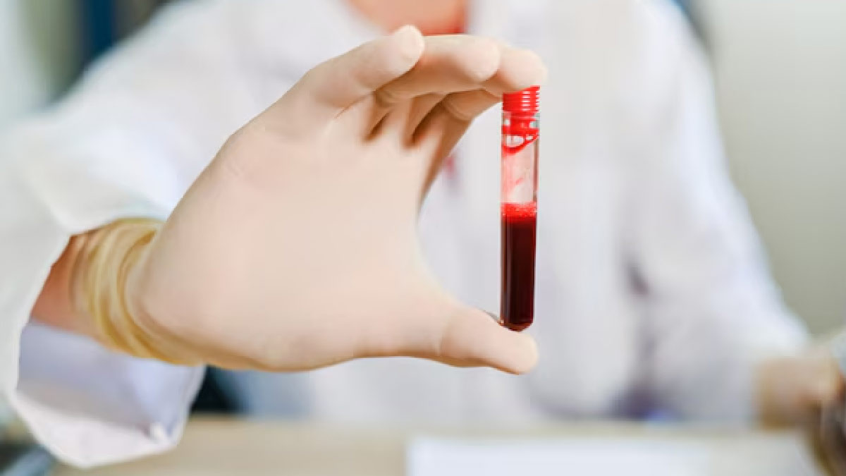 AMH Hormone Level in Female