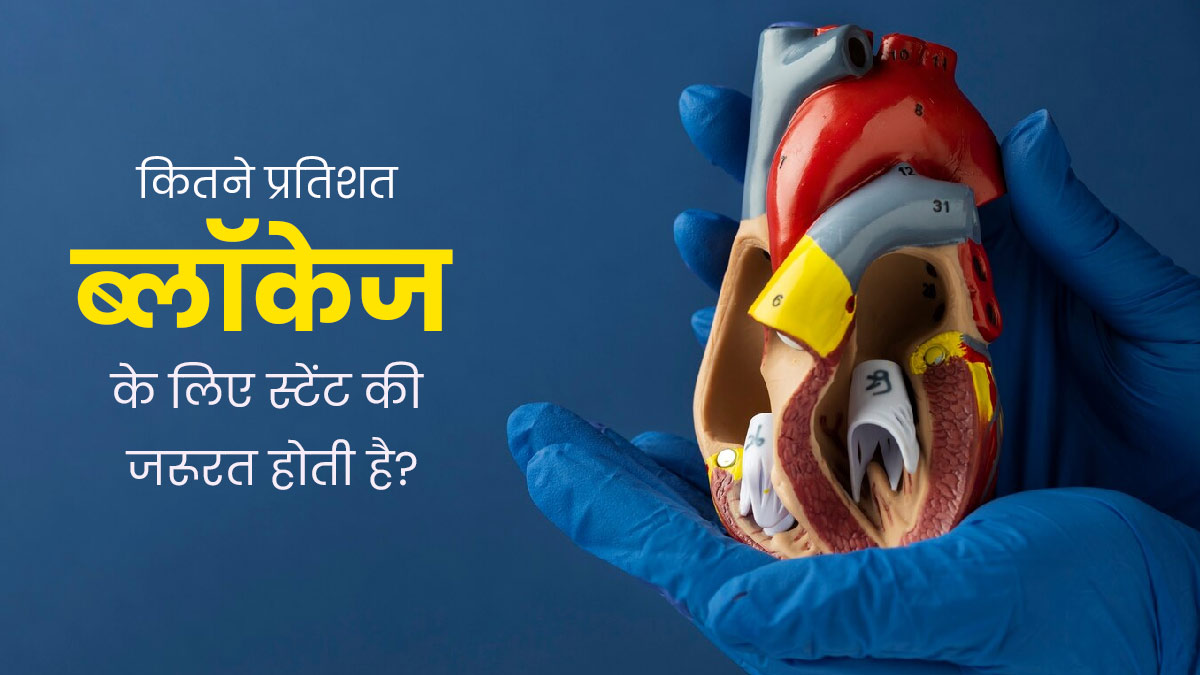 कितने प्रतिशत ब्लॉकेज होने पर स्टेंट लगवाना पड़ता है? जानें डॉक्टर से