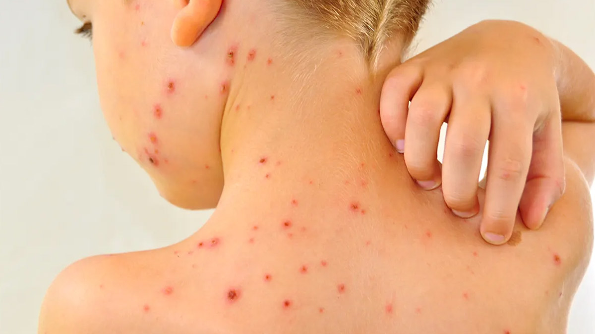 Chickenpox in Kerala:केरल में तेजी से फैल रहा चिकनपॉक्स, सामने आए 6 हजार से ज्यादा मामले और हुई 9 लोगों की मौत