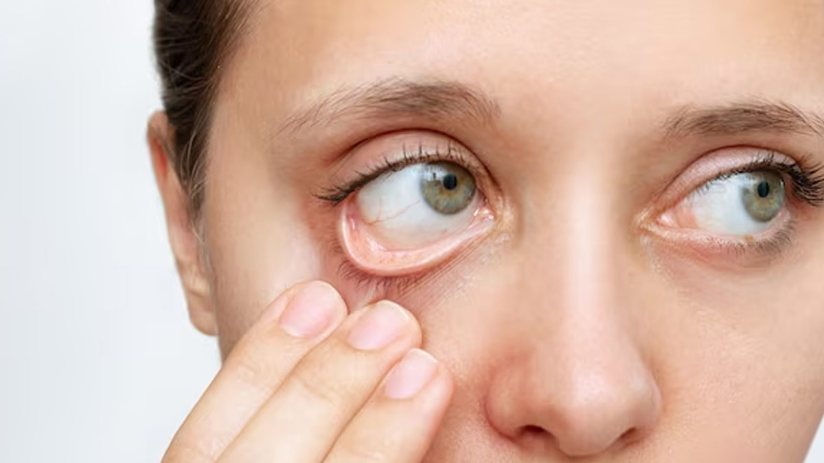 Difference Between Low Iron And Anemia