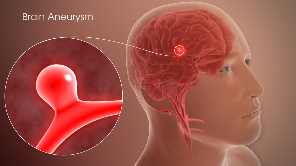 Brain Aneurysm