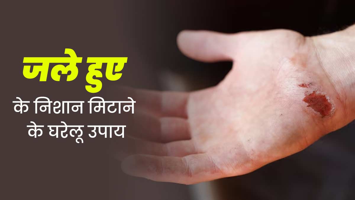 जल गई है त्वचा, तो इसके निशान मिटाने के लिए अपनाएं ये 4 घरेलू उपाय