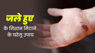 जल गई है त्वचा, तो इसके निशान मिटाने के लिए अपनाएं ये 4 घरेलू उपाय