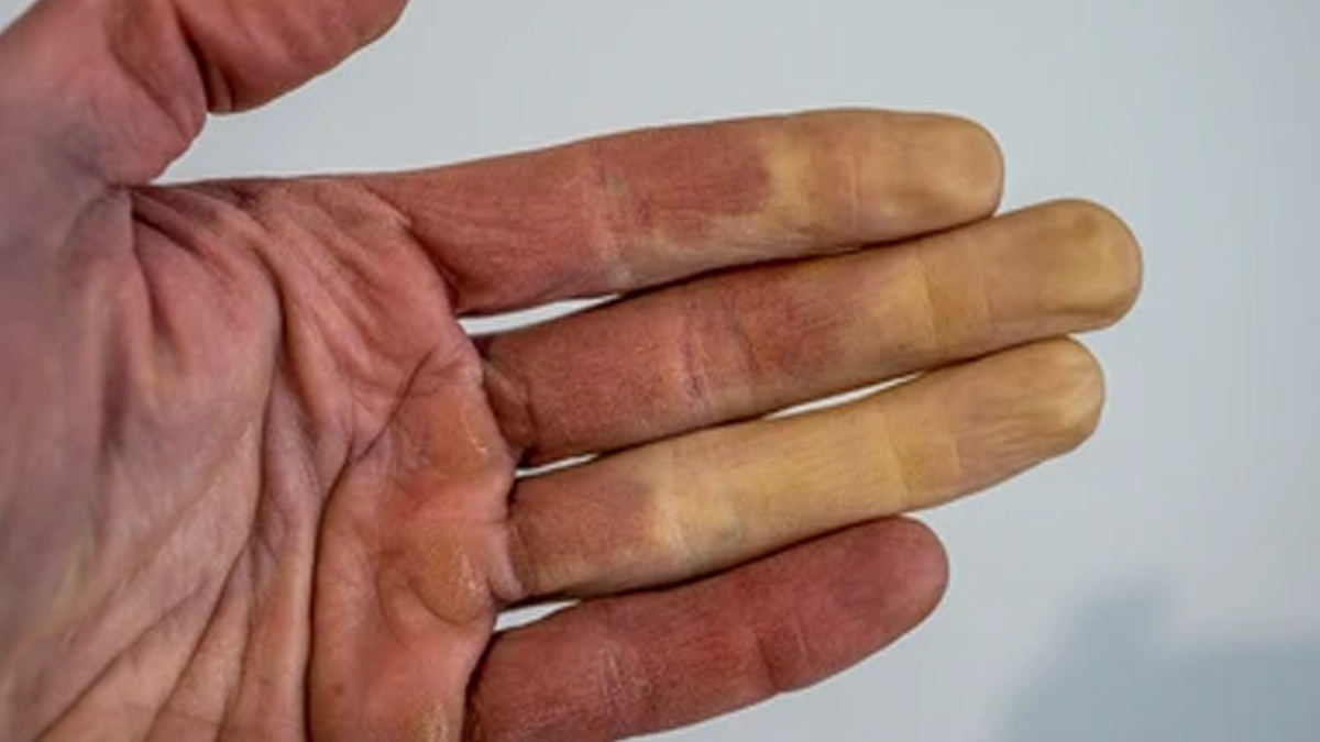 how-raynaud-s-phenomenon-affects-your-fingers-and-toes-what-is-this