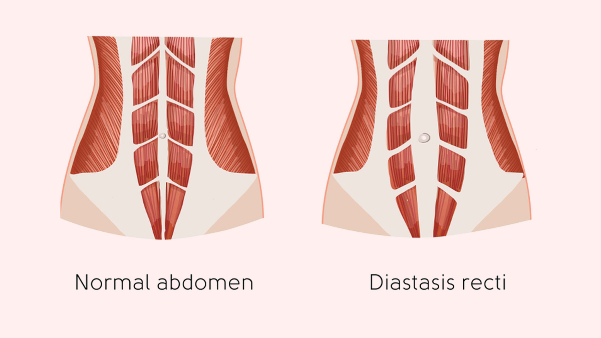 Bulging Tummy Months After Childbirth? It Can Be Sign Of Diastasis Recti,  Know Its Symptoms And Treatment