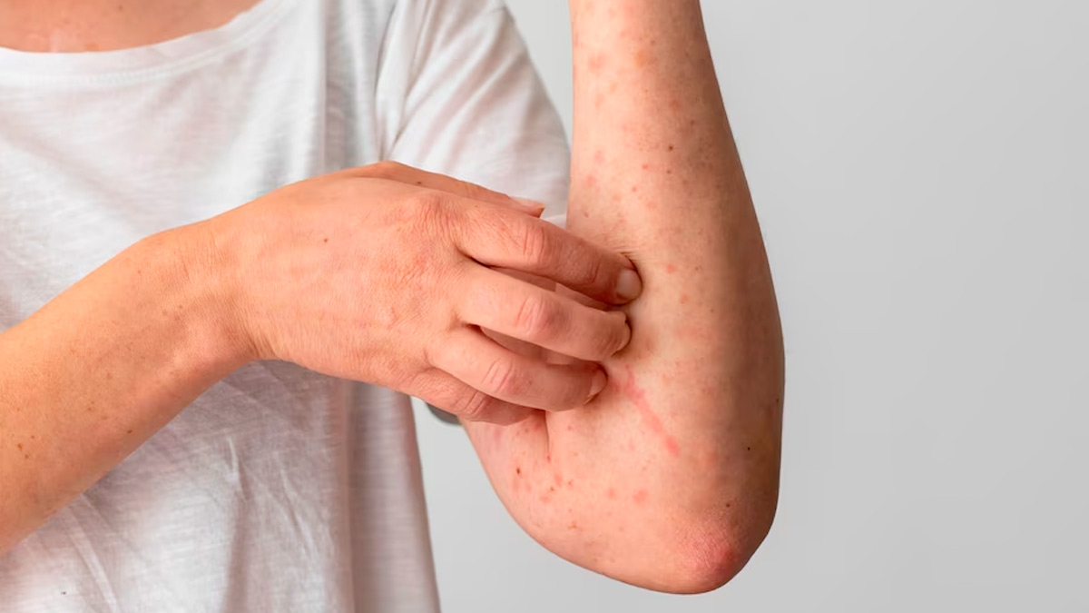 Ways In Which Shingles Can Affect Your Skin Complications and Prevention
