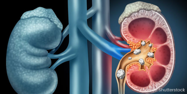 Kidney Stones Symptoms in Men in Their Forties