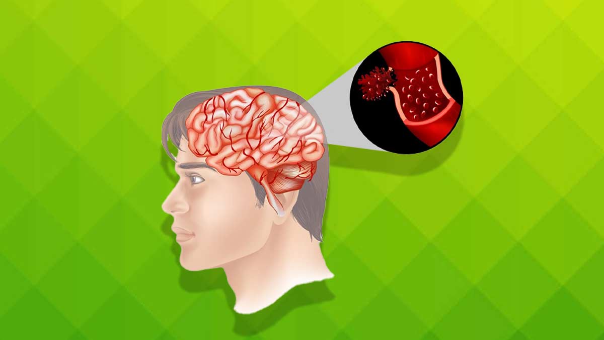 brain bleeding