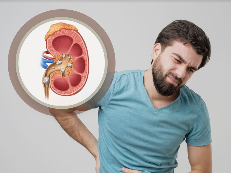 Understanding Kidney Stones: Expert Shares Symptoms in Men in Their 40s