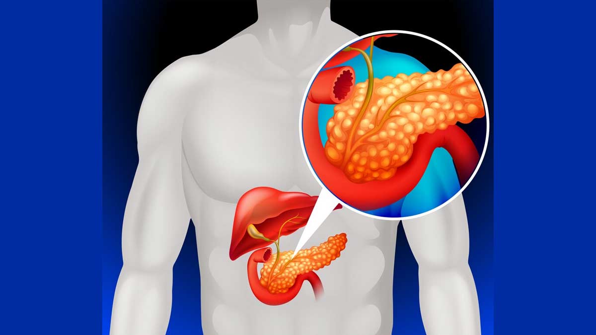Diabetes pacreatic cyst 