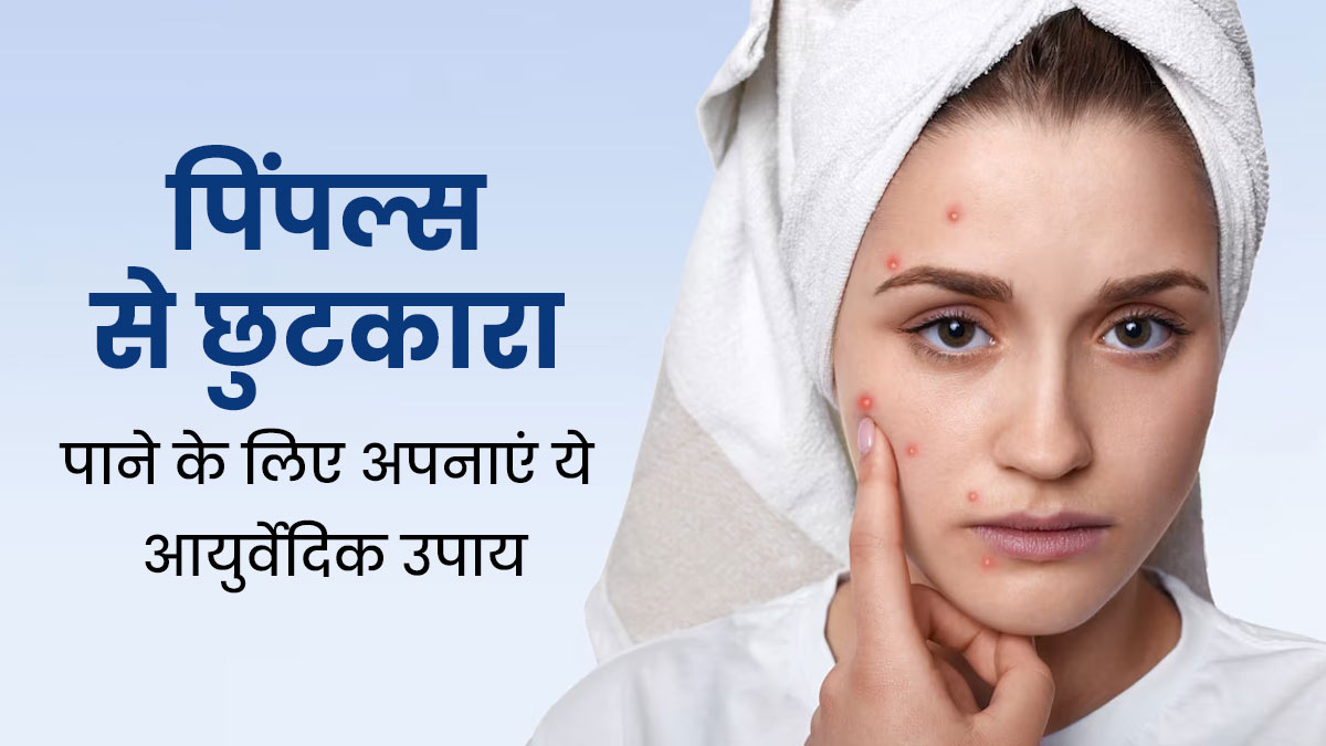 पिंपल्स की समस्या से छुटकारा पाने के लिए अपनाएं ये आयुर्वेदिक उपाय, मिलेगा फायदा