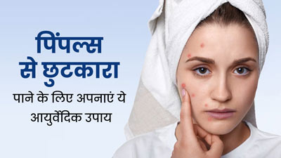 पिंपल्स की समस्या से छुटकारा पाने के लिए अपनाएं ये आयुर्वेदिक उपाय, मिलेगा फायदा