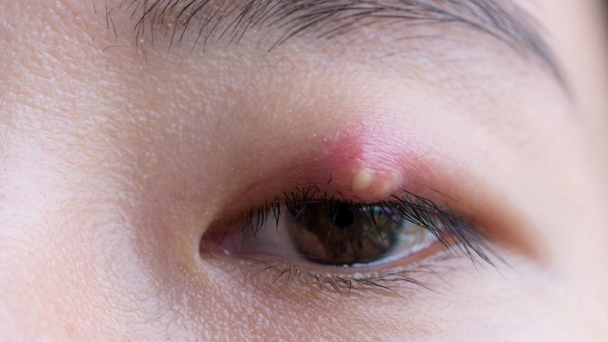 Troubled With A Stye? Try These Effective Home Remedies To Speed Up The Healing Process